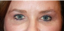 Eyelid Surgery After Photo by Leonard Miller, MD; Brookline, MA - Case 41168