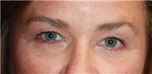 Eyelid Surgery Before Photo by Leonard Miller, MD; Brookline, MA - Case 41168