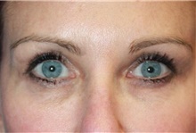 Eyelid Surgery After Photo by Leonard Miller, MD; Brookline, MA - Case 41169
