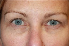 Eyelid Surgery Before Photo by Leonard Miller, MD; Brookline, MA - Case 41169