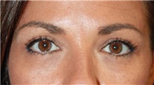 Eyelid Surgery After Photo by Leonard Miller, MD; Brookline, MA - Case 41170