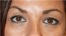 Eyelid Surgery Before Photo by Leonard Miller, MD; Brookline, MA - Case 41170