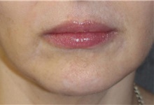 Lip Augmentation/Enhancement After Photo by Leonard Miller, MD; Brookline, MA - Case 41171