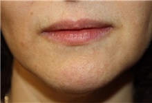 Lip Augmentation/Enhancement Before Photo by Leonard Miller, MD; Brookline, MA - Case 41171