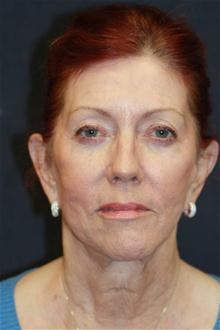 Dermal Fillers After Photo by Kris Reddy, MD, FACS; Lake Worth, FL - Case 28623