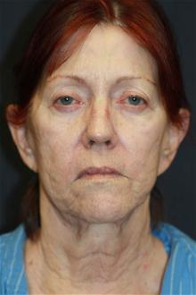 Dermal Fillers Before Photo by Kris Reddy, MD, FACS; Lake Worth, FL - Case 28623