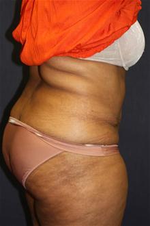 Tummy Tuck After Photo by Kris Reddy, MD, FACS; Lake Worth, FL - Case 28624