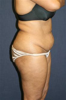 Tummy Tuck Before Photo by Kris Reddy, MD, FACS; Lake Worth, FL - Case 28624