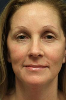 Facelift After Photo by Kris Reddy, MD, FACS; Lake Worth, FL - Case 28625