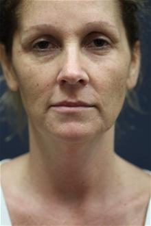 Facelift Before Photo by Kris Reddy, MD, FACS; Lake Worth, FL - Case 28625