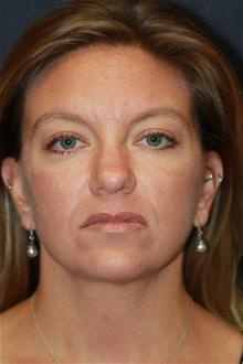 Facelift After Photo by Kris Reddy, MD, FACS; Lake Worth, FL - Case 28638