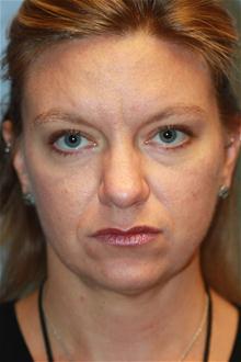 Facelift Before Photo by Kris Reddy, MD, FACS; Lake Worth, FL - Case 28638