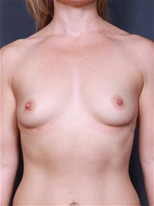 Breast Augmentation Before Photo by Lori Saltz, MD; La Jolla, CA - Case 25482