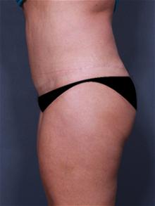 Tummy Tuck After Photo by Lori Saltz, MD; La Jolla, CA - Case 25552