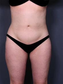 Liposuction After Photo by Lori Saltz, MD; La Jolla, CA - Case 25569