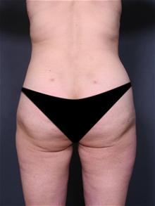Liposuction After Photo by Lori Saltz, MD; La Jolla, CA - Case 25569