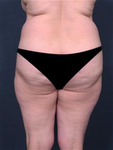 Liposuction Before Photo by Lori Saltz, MD; La Jolla, CA - Case 25569