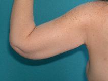 Arm Lift After Photo by Peter Johnson, MD; Des Plaines, IL - Case 9933