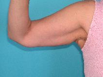 Arm Lift After Photo by Peter Johnson, MD; Des Plaines, IL - Case 9940