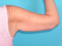 Arm Lift After Photo by Peter Johnson, MD; Des Plaines, IL - Case 9940
