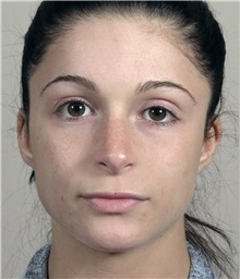 Rhinoplasty After Photo by Paul Parker, MD; Paramus, NJ - Case 35094