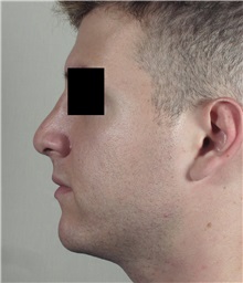 Rhinoplasty After Photo by Paul Parker, MD; Paramus, NJ - Case 35095