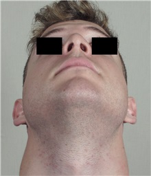 Rhinoplasty After Photo by Paul Parker, MD; Paramus, NJ - Case 35095