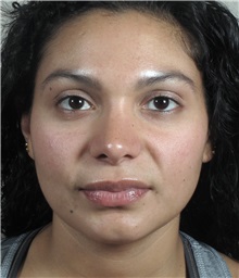 Rhinoplasty After Photo by Paul Parker, MD; Paramus, NJ - Case 35096