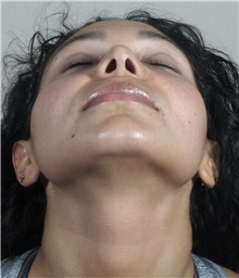 Rhinoplasty After Photo by Paul Parker, MD; Paramus, NJ - Case 35096