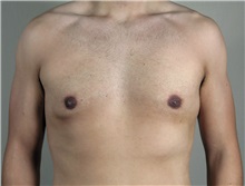 Male Breast Reduction After Photo by Paul Parker, MD; Paramus, NJ - Case 35097