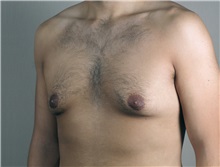 Male Breast Reduction Before Photo by Paul Parker, MD; Paramus, NJ - Case 35097