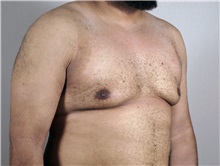 Male Breast Reduction After Photo by Paul Parker, MD; Paramus, NJ - Case 35100