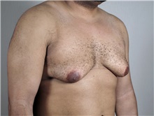 Male Breast Reduction Before Photo by Paul Parker, MD; Paramus, NJ - Case 35100