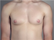 Male Breast Reduction Before Photo by Paul Parker, MD; Paramus, NJ - Case 35101