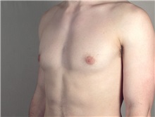 Male Breast Reduction After Photo by Paul Parker, MD; Paramus, NJ - Case 35101