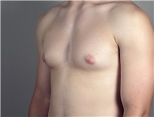 Male Breast Reduction Before Photo by Paul Parker, MD; Paramus, NJ - Case 35101