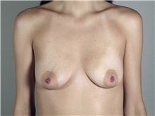 Breast Augmentation Before Photo by Paul Parker, MD; Paramus, NJ - Case 35102