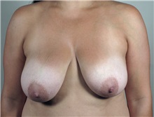 Breast Augmentation Before Photo by Paul Parker, MD; Paramus, NJ - Case 35104