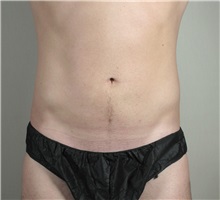 Liposuction After Photo by Paul Parker, MD; Paramus, NJ - Case 35107