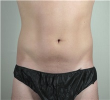 Liposuction Before Photo by Paul Parker, MD; Paramus, NJ - Case 35107