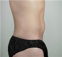 Liposuction Before Photo by Paul Parker, MD; Paramus, NJ - Case 35107