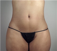 Liposuction After Photo by Paul Parker, MD; Paramus, NJ - Case 35108