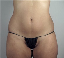 Liposuction Before Photo by Paul Parker, MD; Paramus, NJ - Case 35108