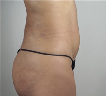 Liposuction After Photo by Paul Parker, MD; Paramus, NJ - Case 35108