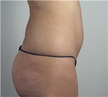 Liposuction Before Photo by Paul Parker, MD; Paramus, NJ - Case 35108