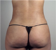 Liposuction After Photo by Paul Parker, MD; Paramus, NJ - Case 35108