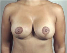 Breast Lift After Photo by Paul Parker, MD; Paramus, NJ - Case 35111