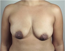 Breast Lift Before Photo by Paul Parker, MD; Paramus, NJ - Case 35111