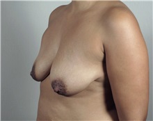 Breast Lift Before Photo by Paul Parker, MD; Paramus, NJ - Case 35111