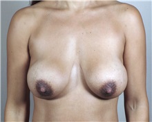 Breast Lift Before Photo by Paul Parker, MD; Paramus, NJ - Case 35114